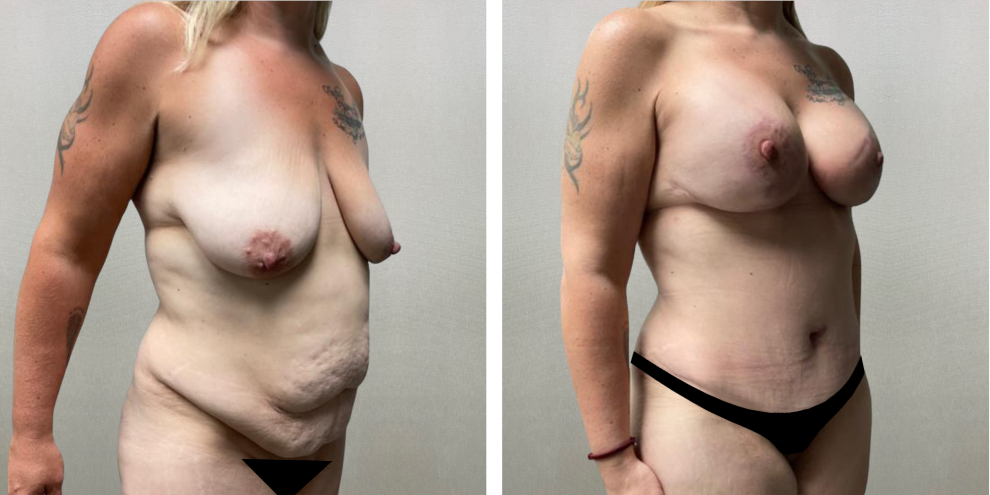 Best Mommy Makeover in Michigan ()