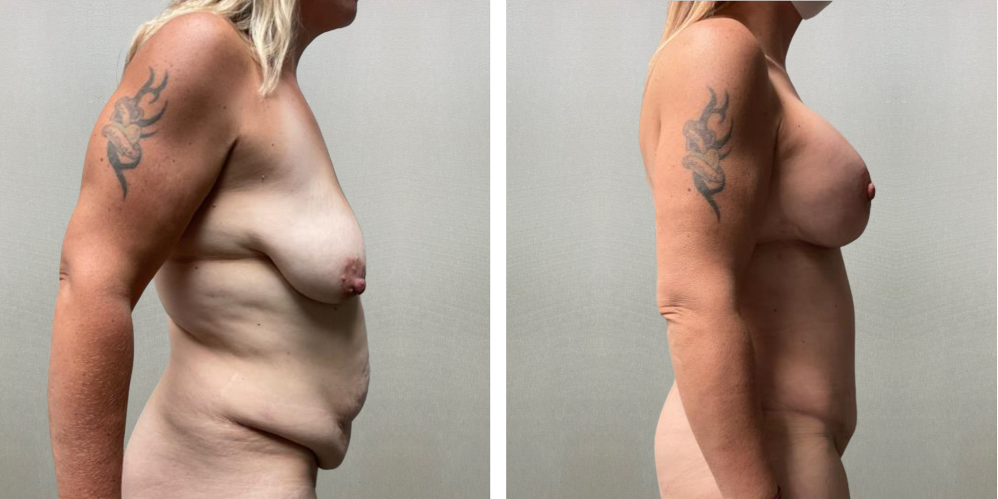 Best Mommy Makeover in Michigan ()