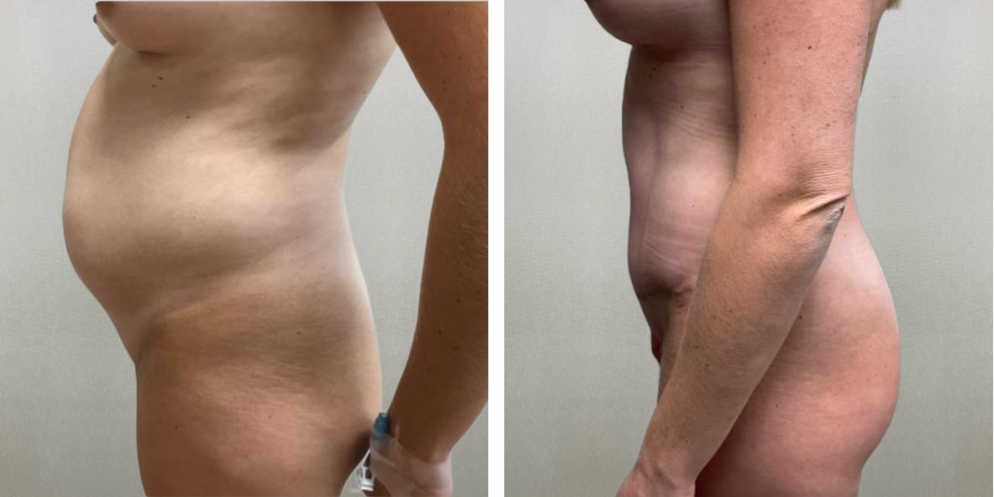 Best Mommy Makeover in Midwest ()