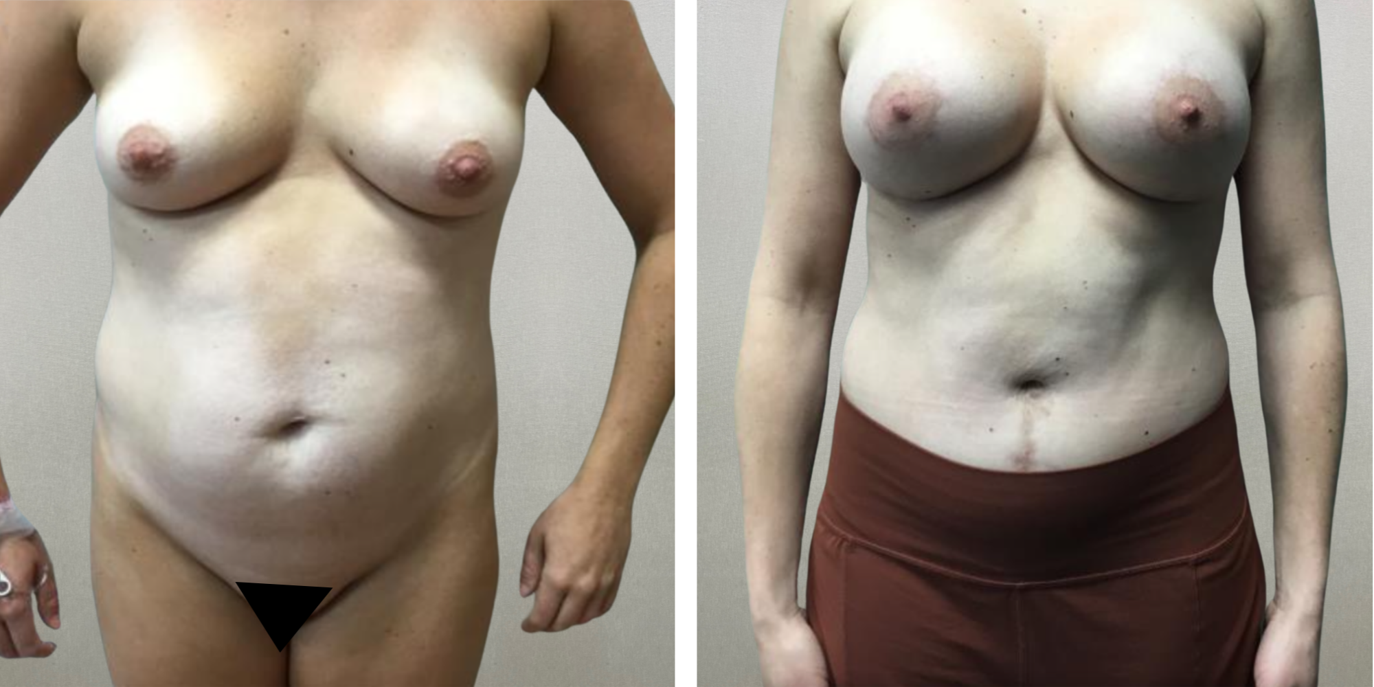 Best Mommy Makeover in Midwest