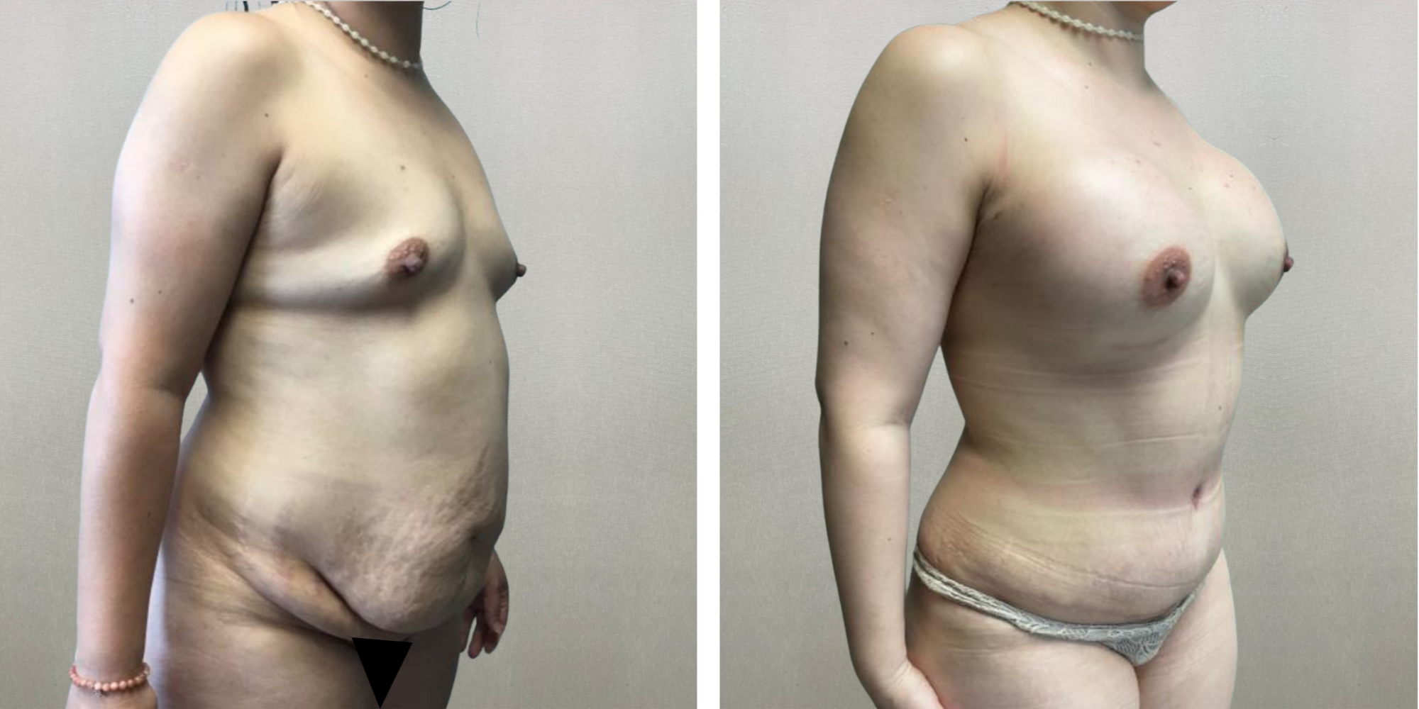 Best Mommy Makeover in Soutfield Michigan ()