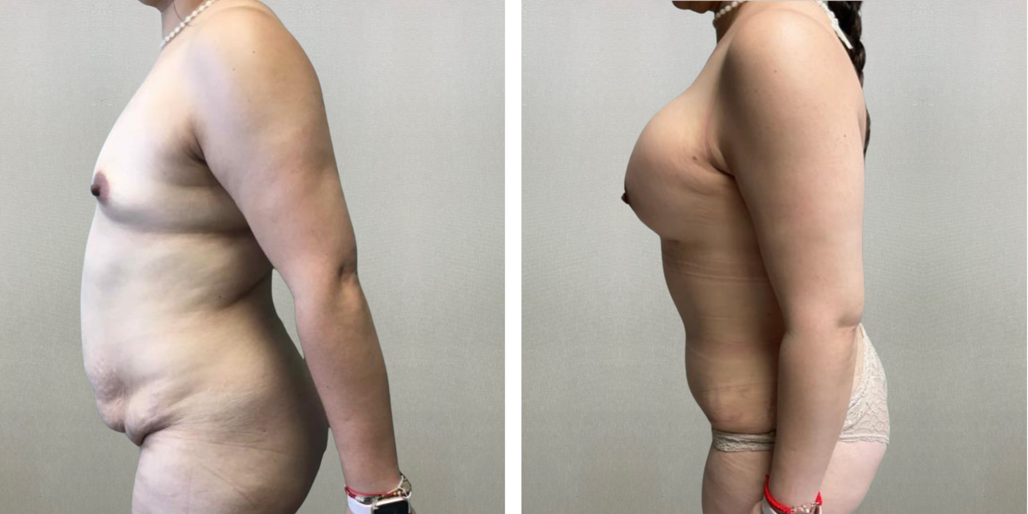 Best Mommy Makeover in Soutfield Michigan ()