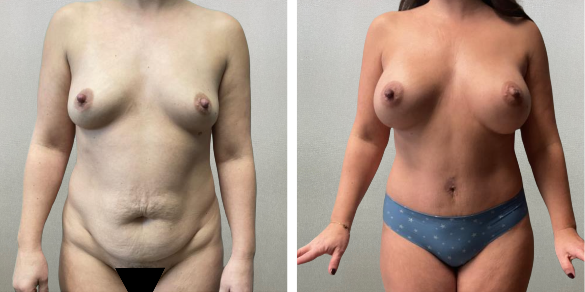 Best Mommy Makeover in Troy Michigan