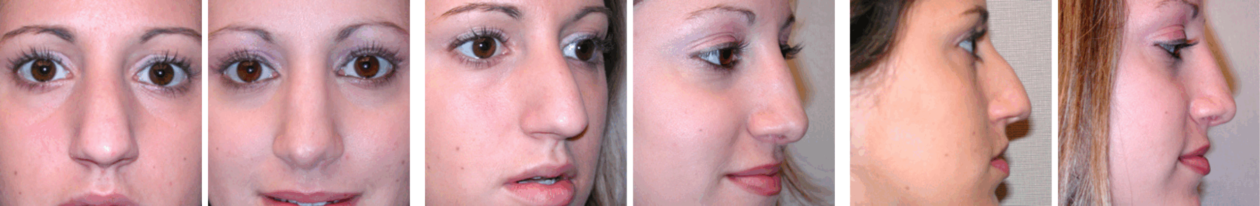 Best Rhinoplasty in Michigan ()