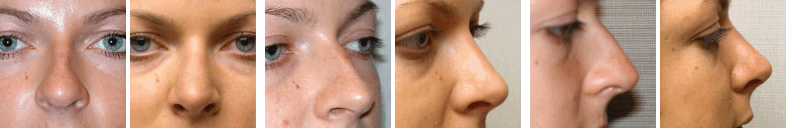 Best Rhinoplasty in Michigan ()