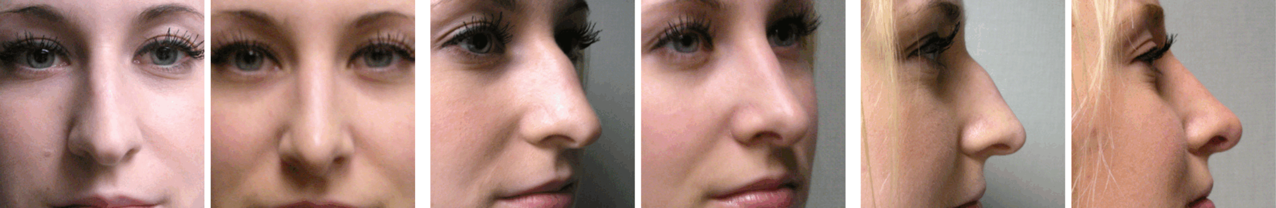 Best Rhinoplasty in Michigan ()