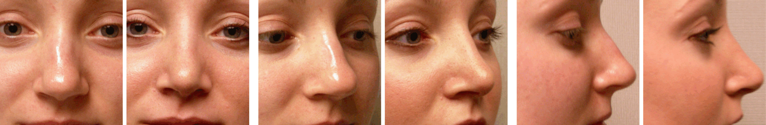 Best Rhinoplasty in Michigan ()