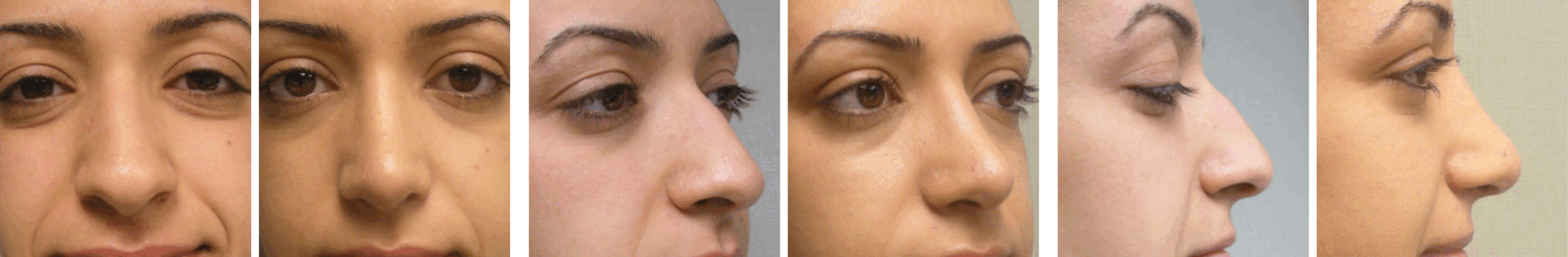 Best Rhinoplasty in Michigan ()