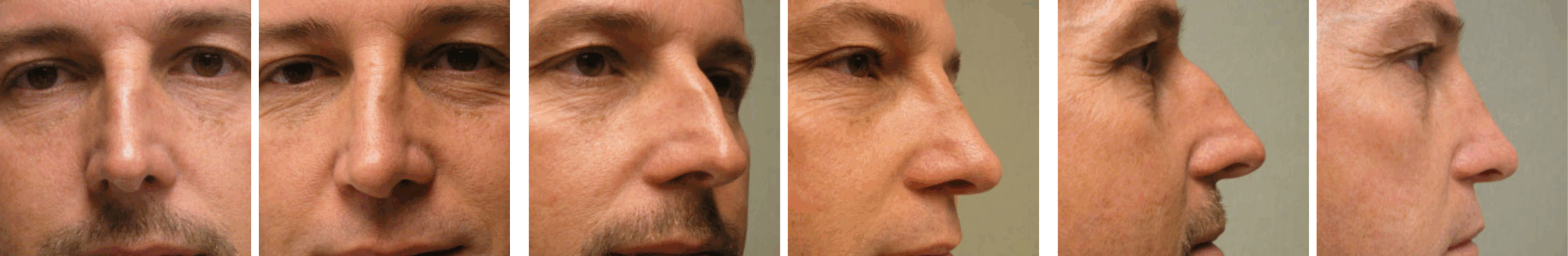 Best Rhinoplasty in Michigan ()