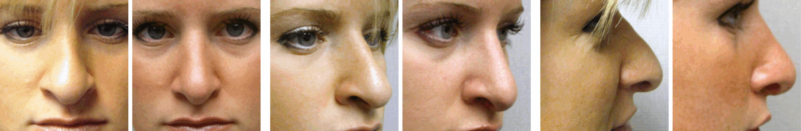 Best Rhinoplasty in Michigan ()