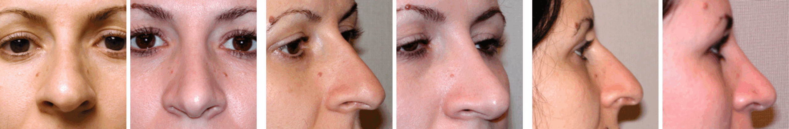 Best Rhinoplasty in Michigan ()