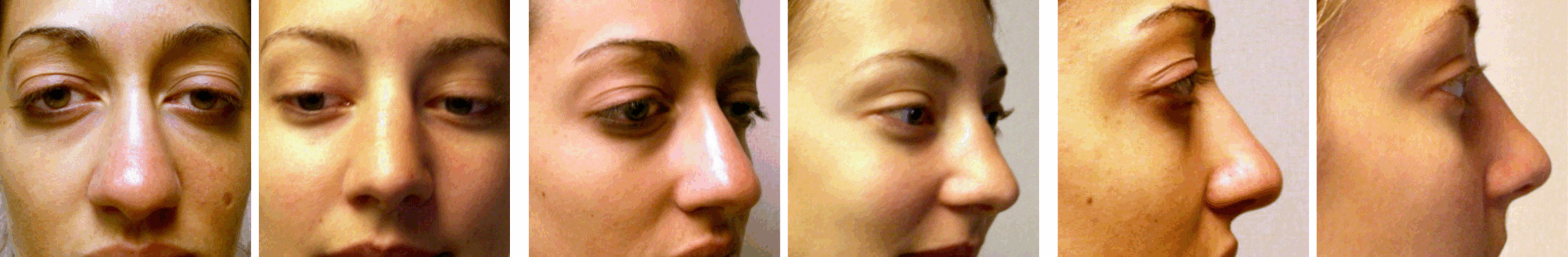 Best Rhinoplasty in Michigan ()