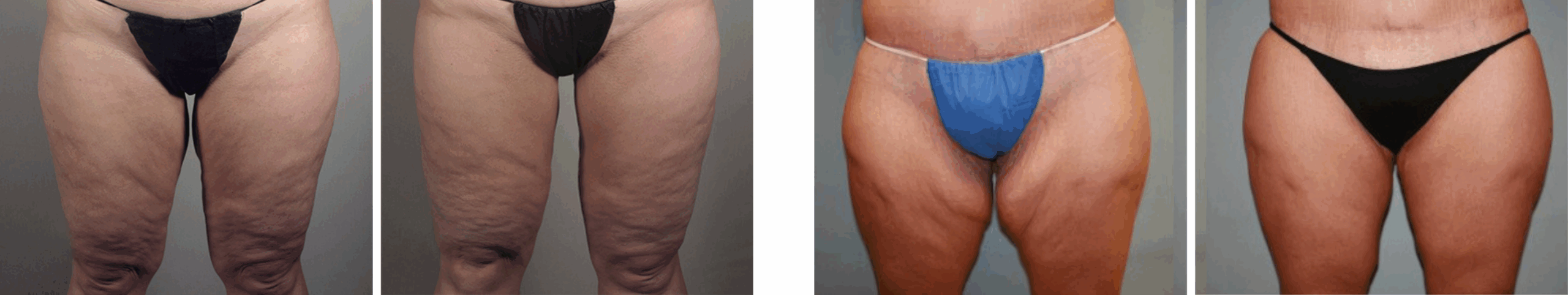 Best Thigh Lift In Michgian ()