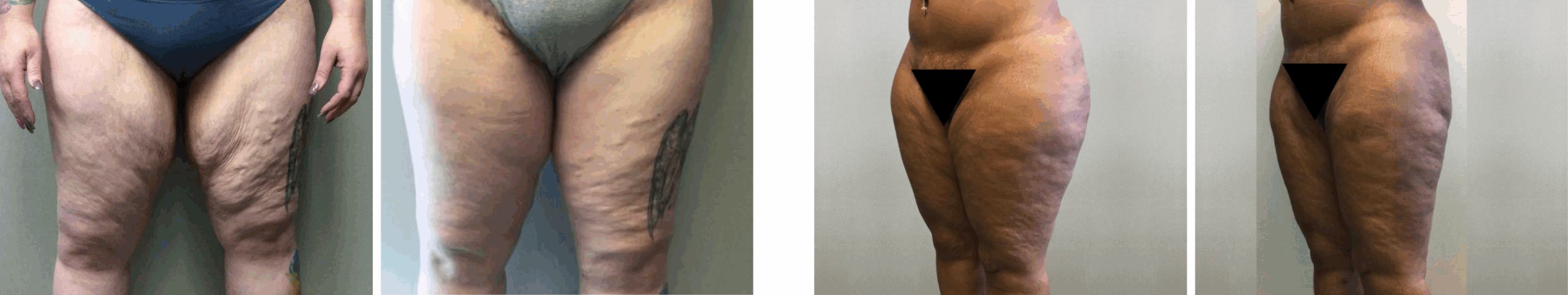 Best Thigh Lift In Michgian ()