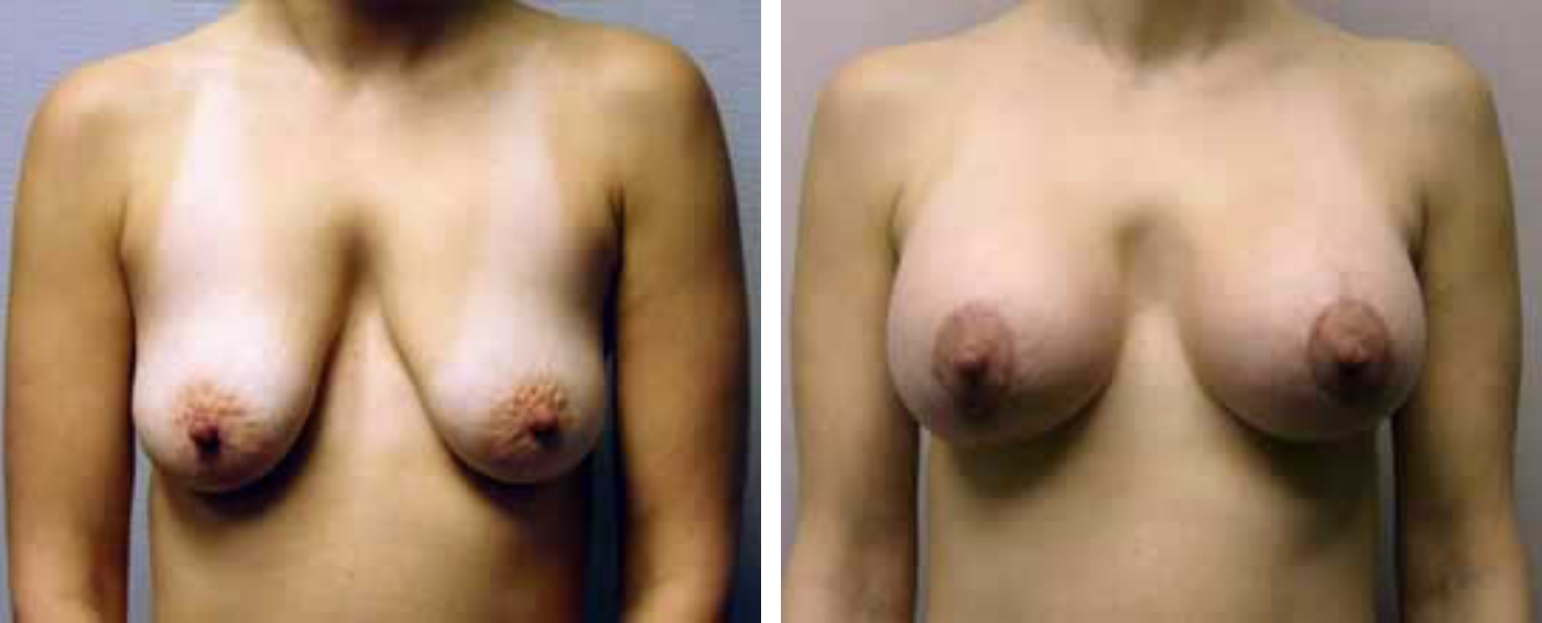 Breast Augmentation with Lollipop Lift a