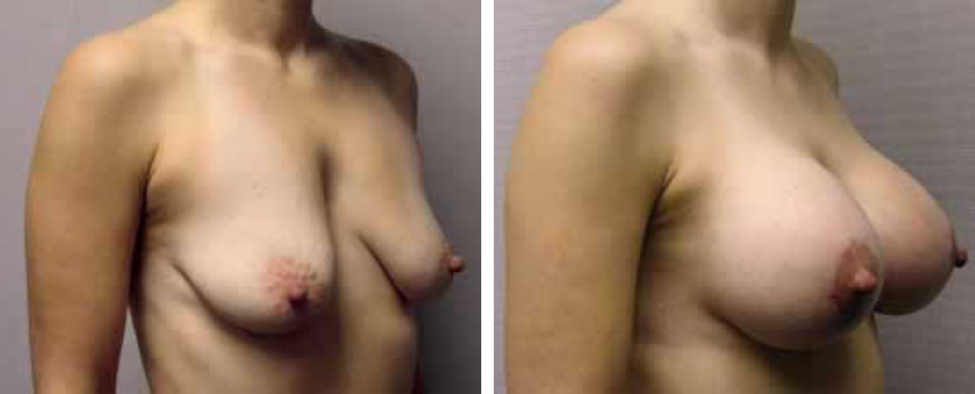 Breast Augmentation with Lollipop Lift b