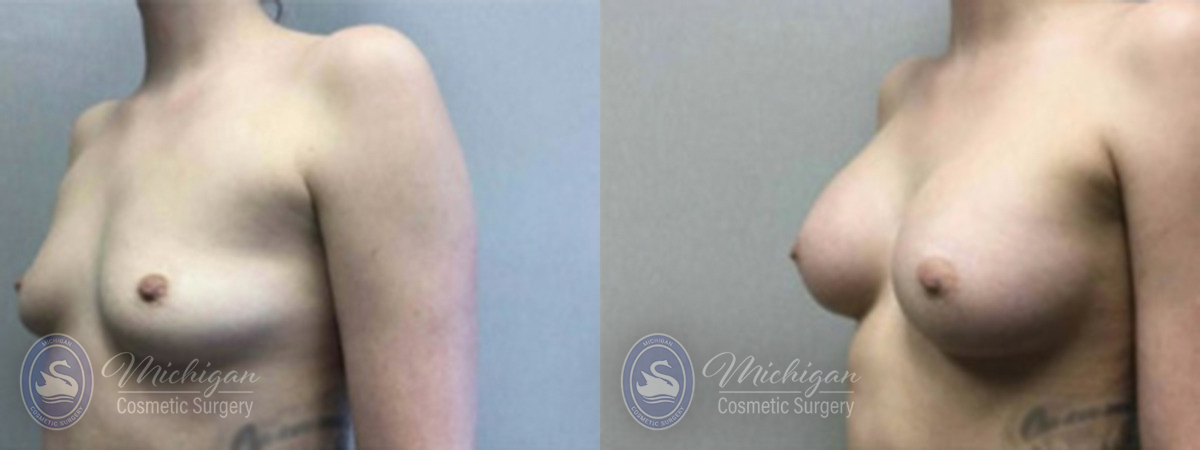 Michigan Cosmetic Surgery Southfield Breast Augmentation P