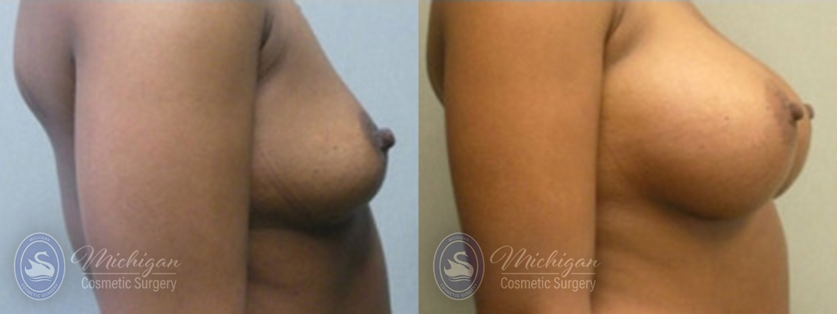 Michigan Cosmetic Surgery Southfield Breast Augmentation P