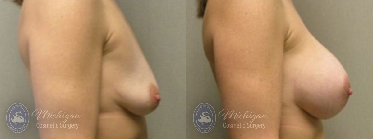 Michigan Cosmetic Surgery Southfield Breast Augmentation P