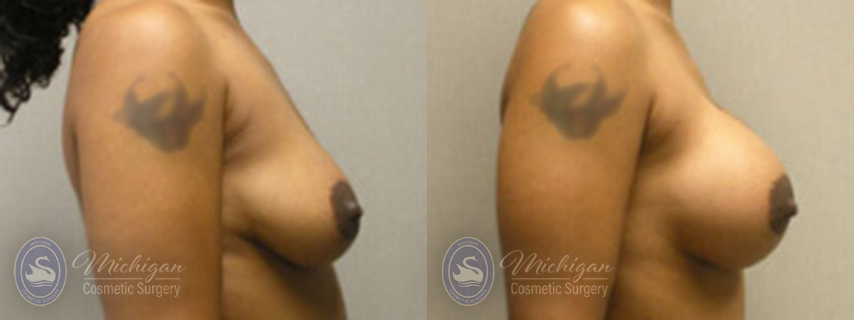 Michigan Cosmetic Surgery Southfield Breast Augmentation P