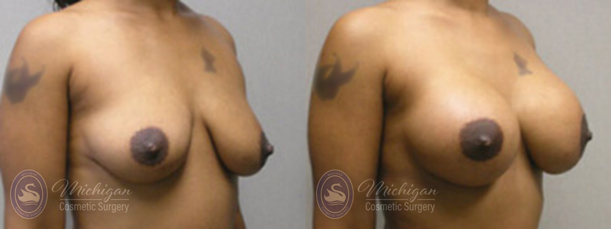 Michigan Cosmetic Surgery Southfield Breast Augmentation P