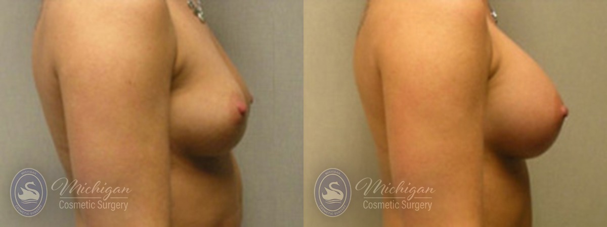Michigan Cosmetic Surgery Southfield Breast Augmentation P