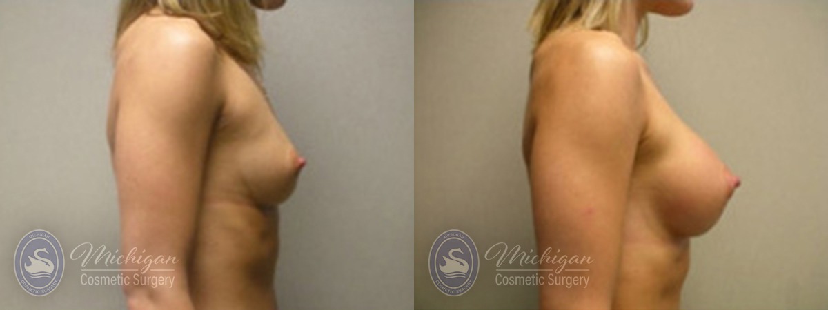 Michigan Cosmetic Surgery Southfield Breast Augmentation P