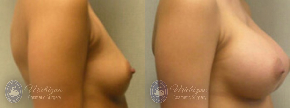 Michigan Cosmetic Surgery Southfield Breast Augmentation P
