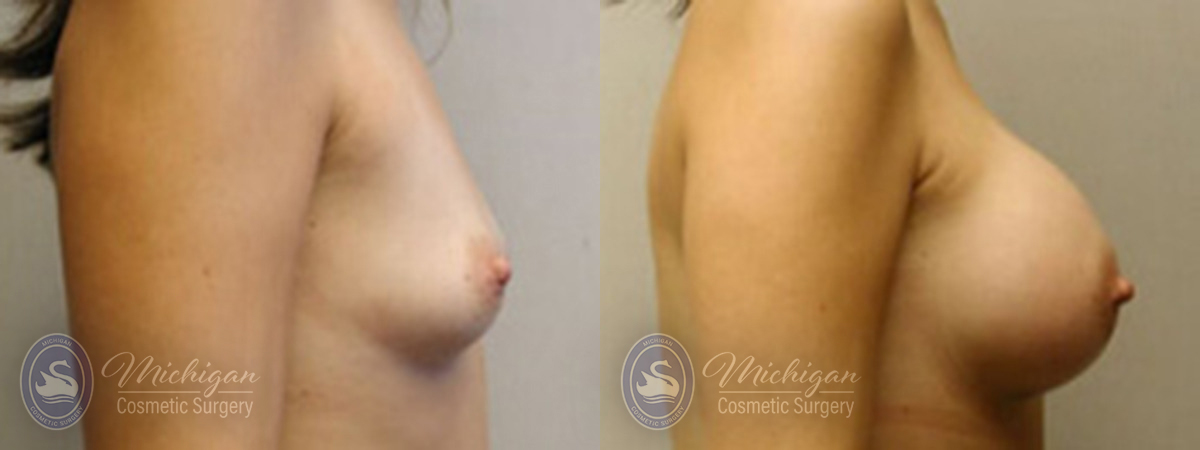 Michigan Cosmetic Surgery Southfield Breast Augmentation P
