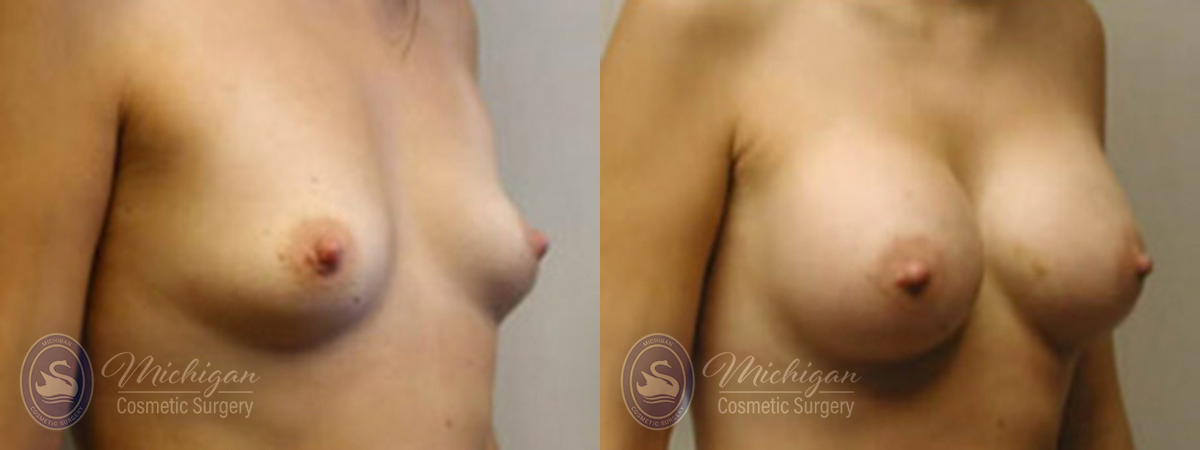 Michigan Cosmetic Surgery Southfield Breast Augmentation P