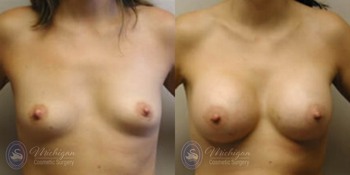 Michigan Cosmetic Surgery Southfield Breast Augmentation P