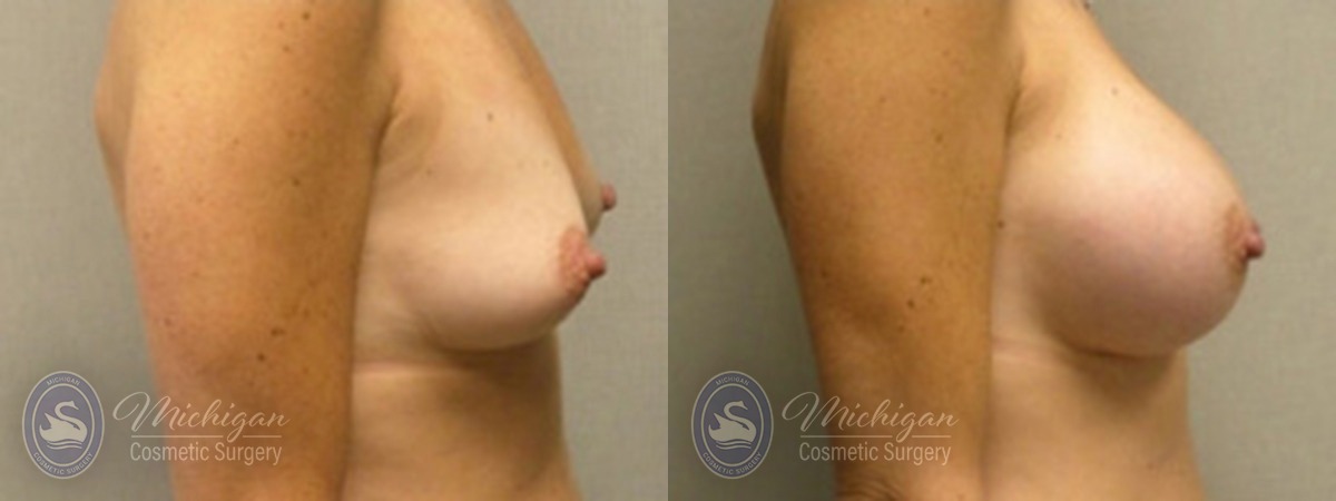Michigan Cosmetic Surgery Southfield Breast Augmentation P