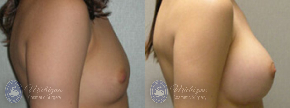 Michigan Cosmetic Surgery Southfield Breast Augmentation P