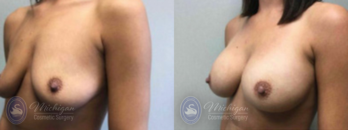 Michigan Cosmetic Surgery Southfield Breast Augmentation P