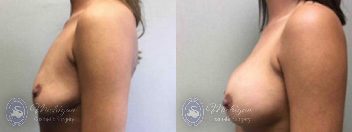 Michigan Cosmetic Surgery Southfield Breast Augmentation P