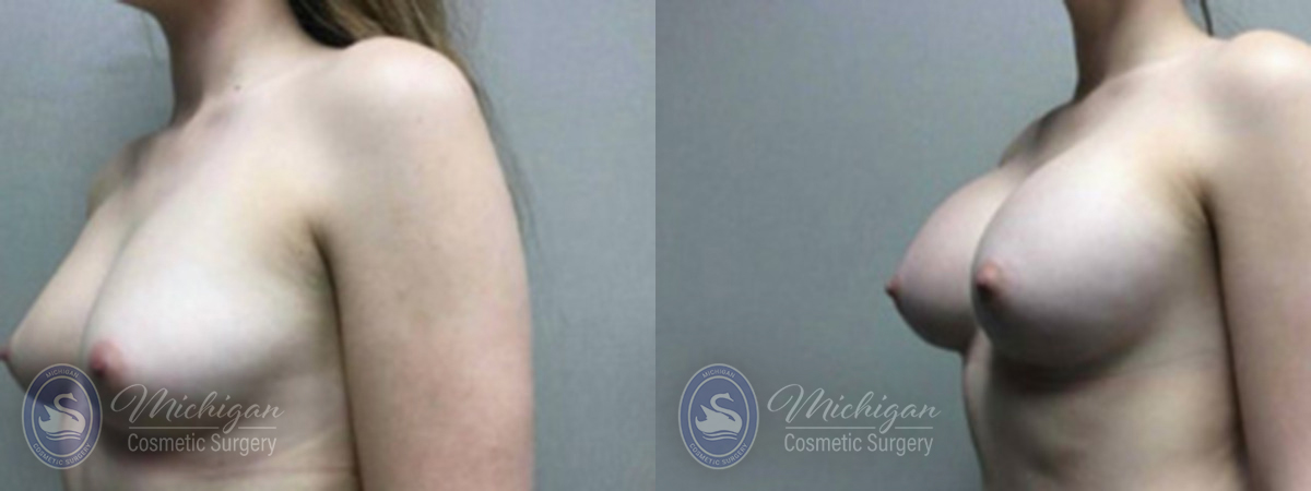 Michigan Cosmetic Surgery Southfield Breast Augmentation P