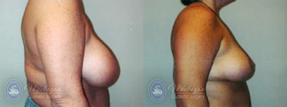 Michigan Cosmetic Surgery Southfield Breast Reduction P