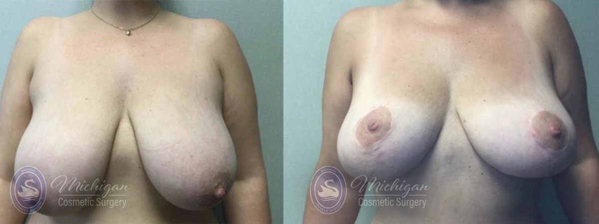 Michigan Cosmetic Surgery Southfield Breast Reduction P