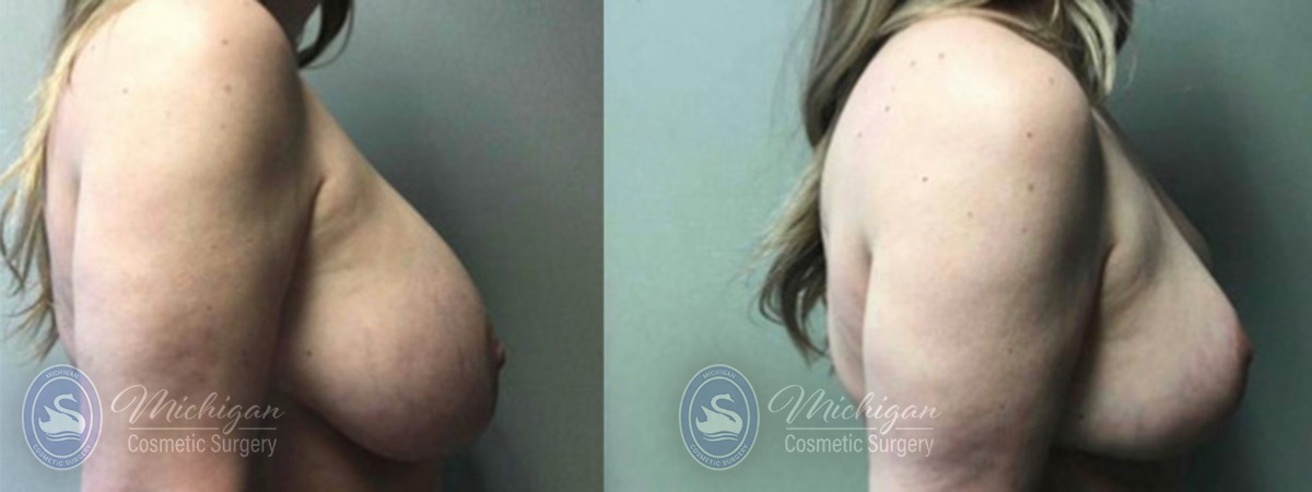 Michigan Cosmetic Surgery Southfield Breast Reduction P