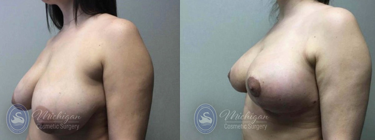 Michigan Cosmetic Surgery Southfield Breast Reduction P