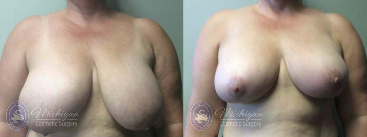 Michigan Cosmetic Surgery Southfield Breast Reduction P