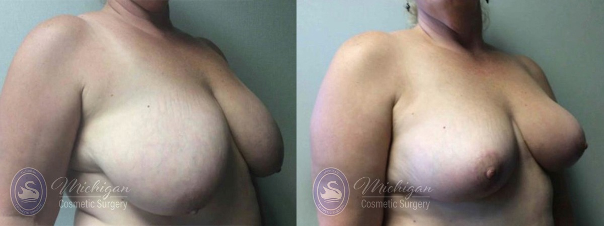 Michigan Cosmetic Surgery Southfield Breast Reduction P