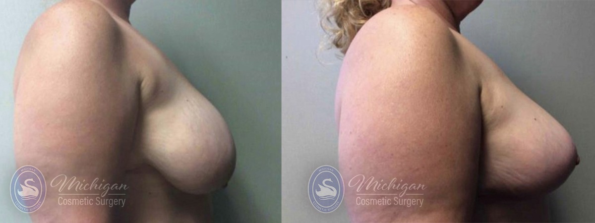 Michigan Cosmetic Surgery Southfield Breast Reduction P