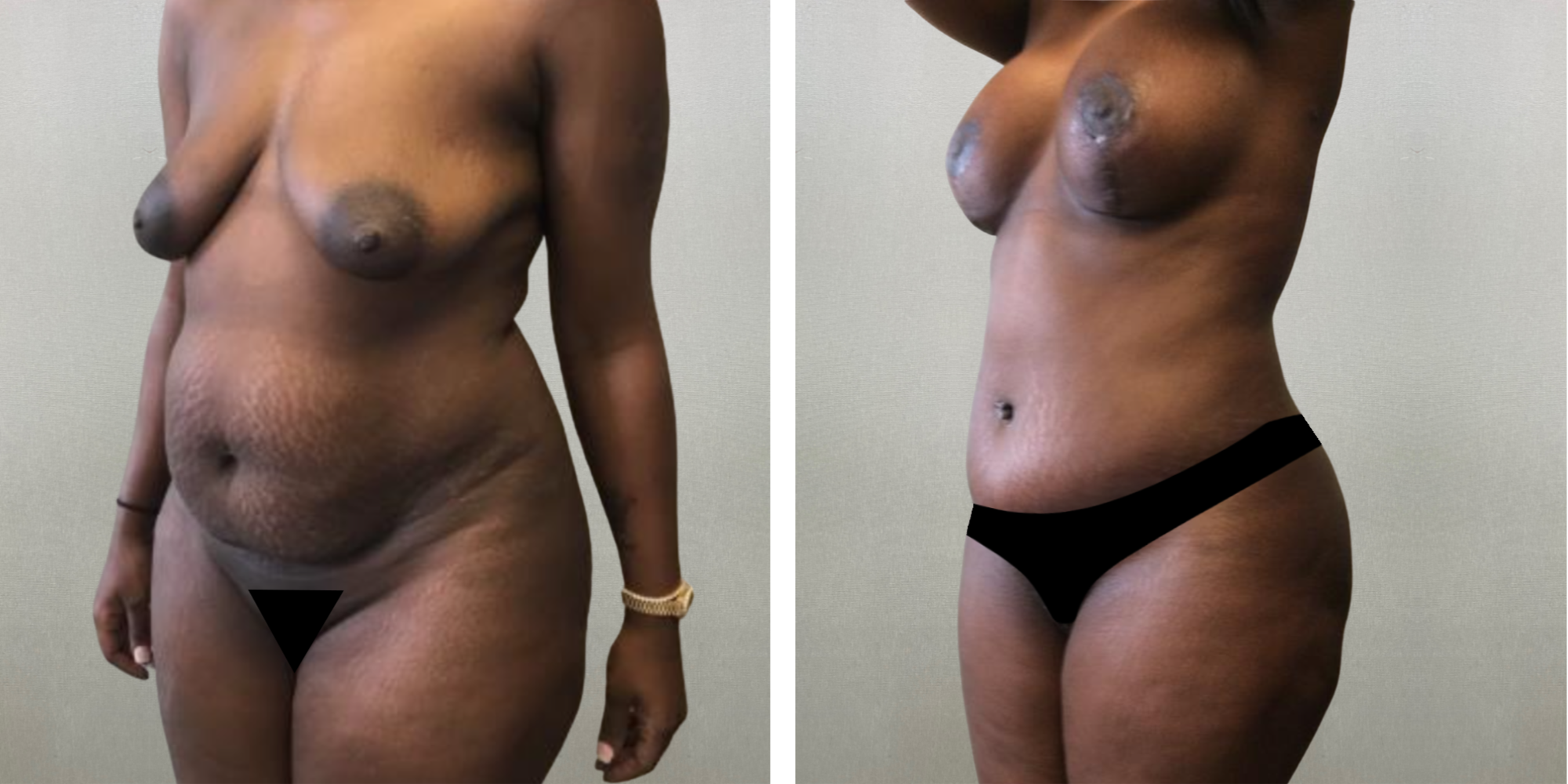 Mommy Makeover at michigagn Cosmetic Surgery ()