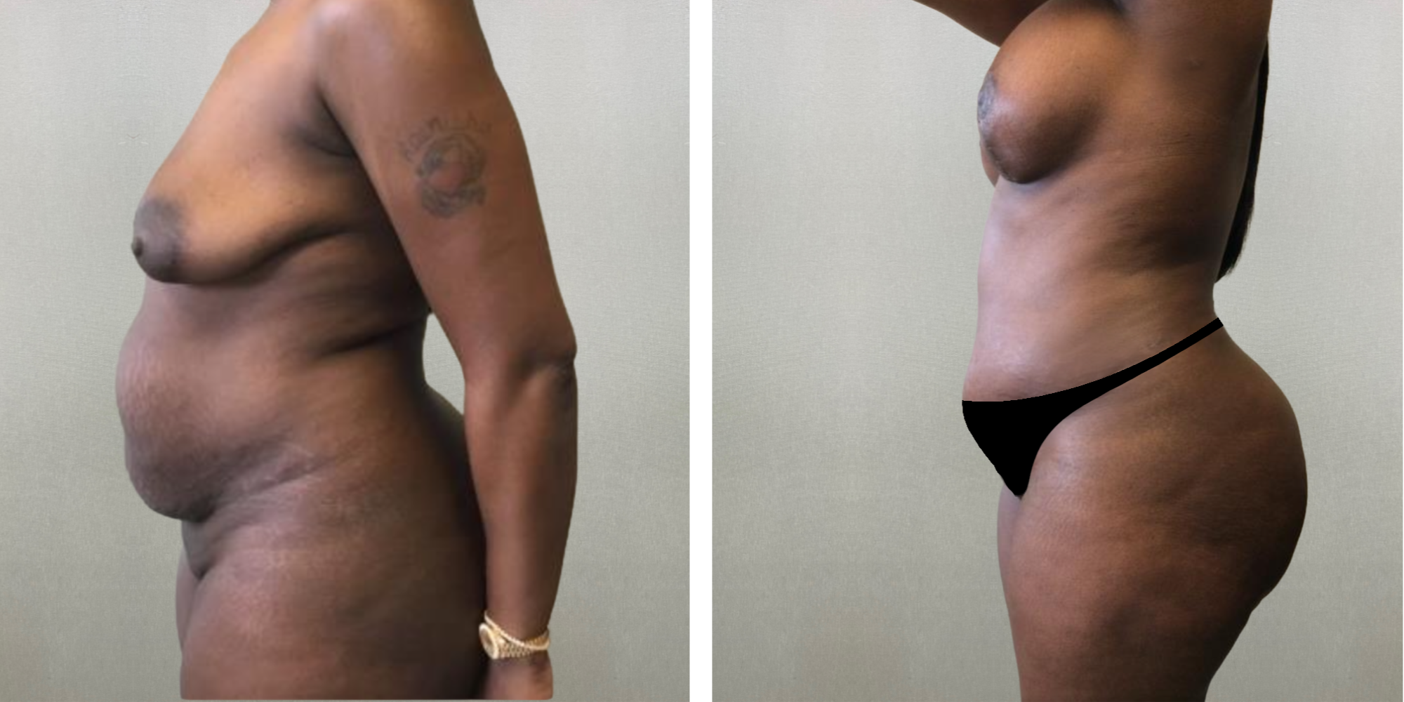 Mommy Makeover at michigagn Cosmetic Surgery ()