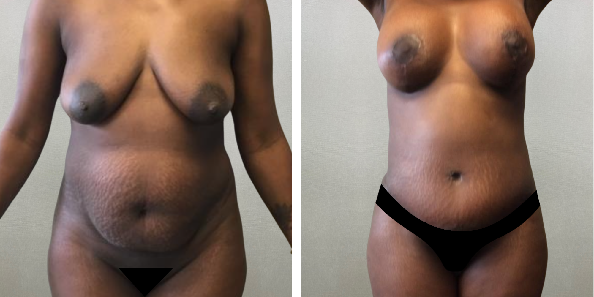 Mommy Makeover at michigagn Cosmetic Surgery