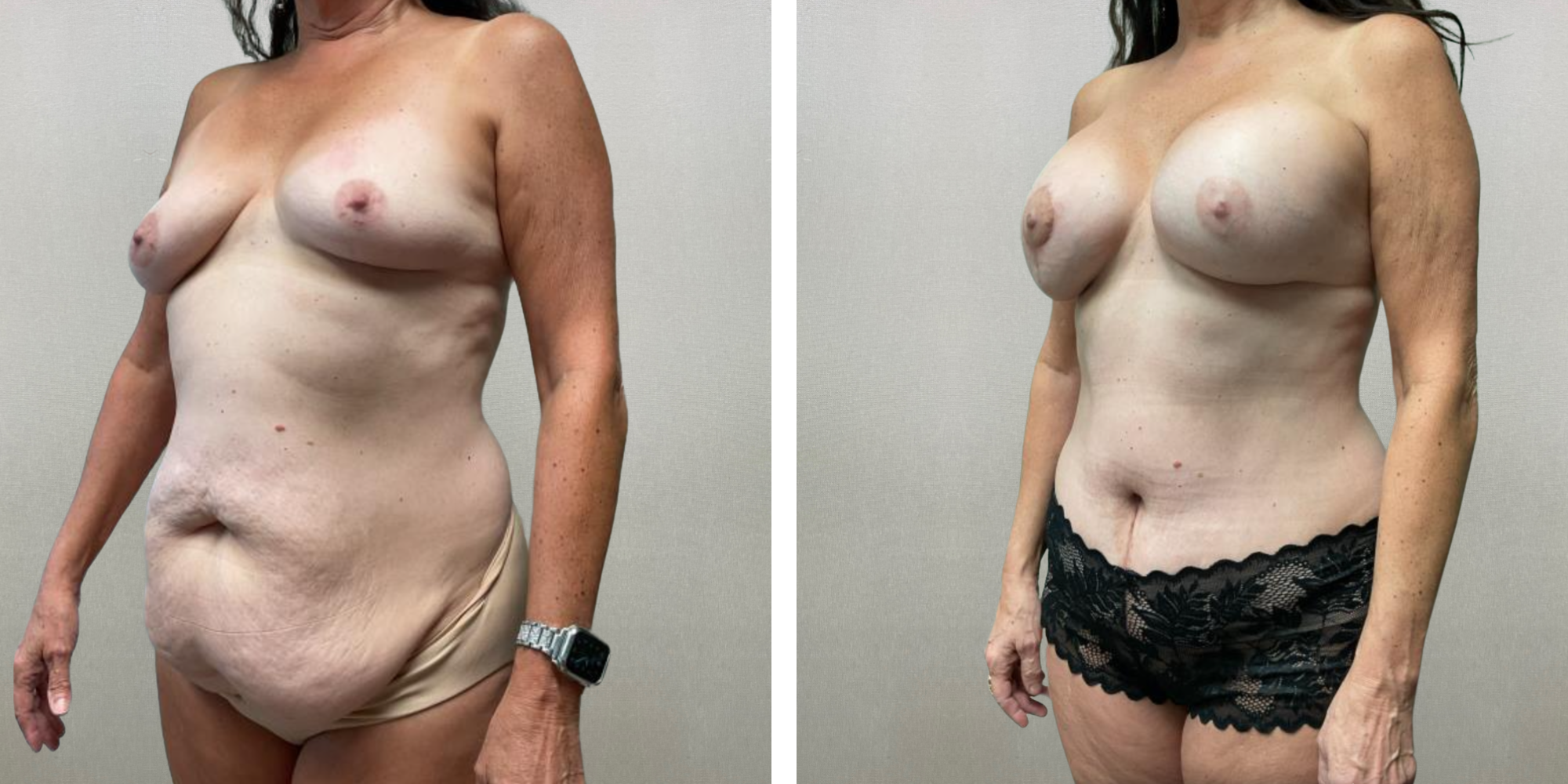 Mommy Makeover in Detroit, Before and After ()