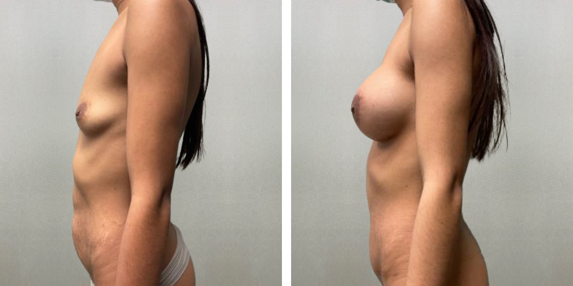 Mommy Makeover in Detroit, Before and After ()