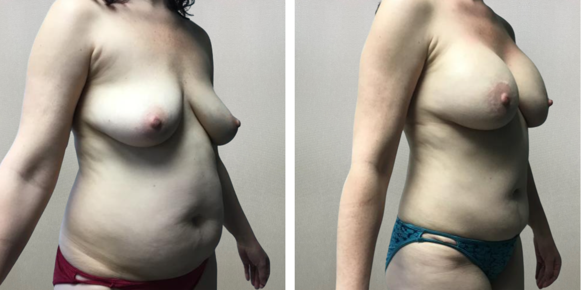 Mommy Makeover in Detroit Michigan ()