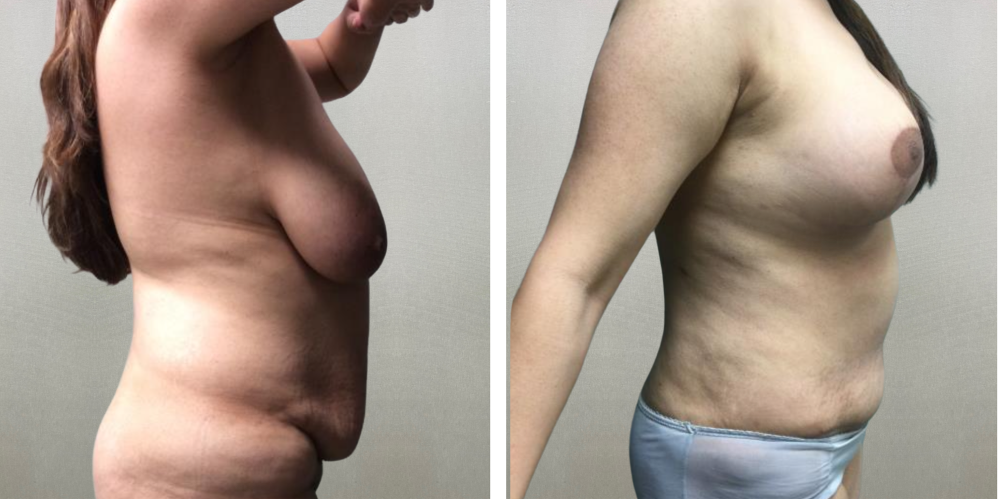 Mommy Makeover in Detroit Michigan ()